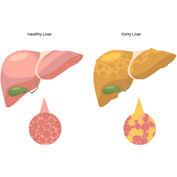 Fatty Liver Disease