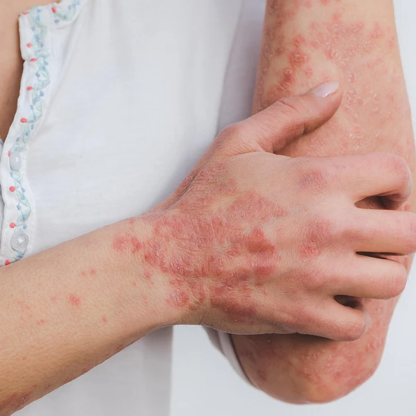 psoriasis
