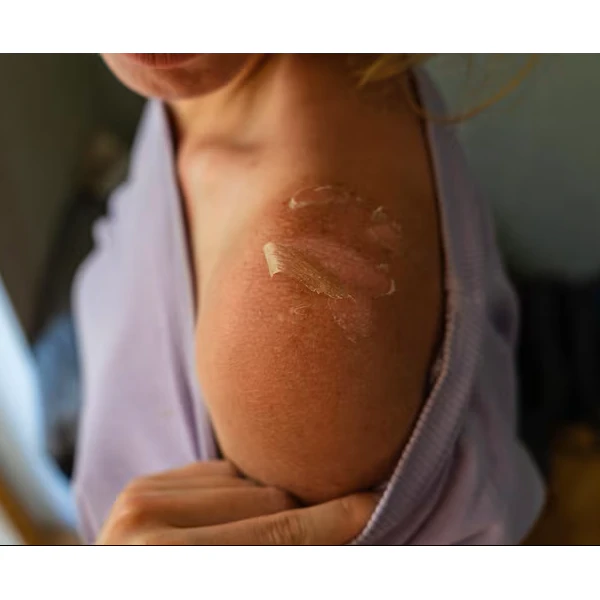 sunburn
