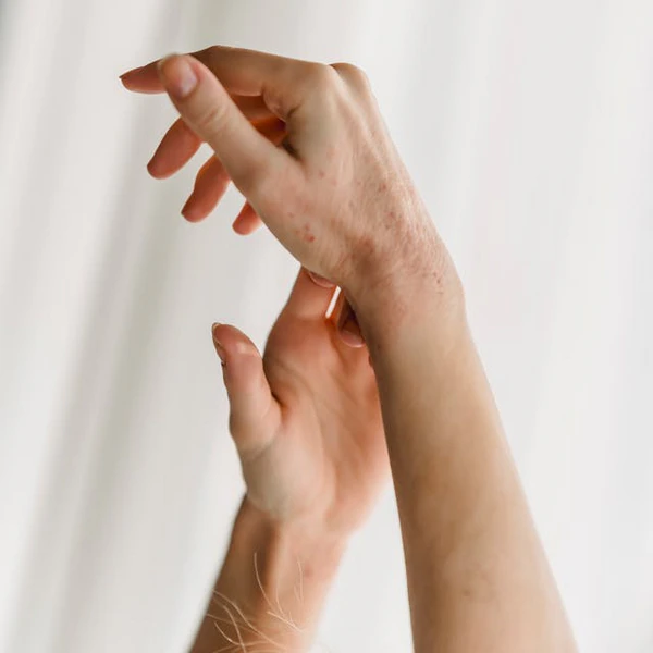 Eczema