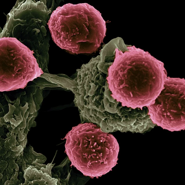 Prostate Cancer